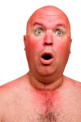 sunburnt-guy