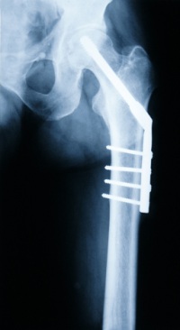 broken-hip